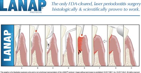 gum disease treatment near me|LANAP Laser Gum Surgery (Procedure, Benefits & Costs).